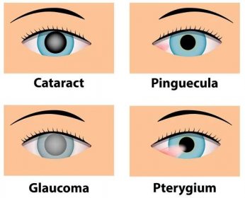 Katarakt, Pinguecula, glaukom a Pterygium, oční péče — Ilustrace