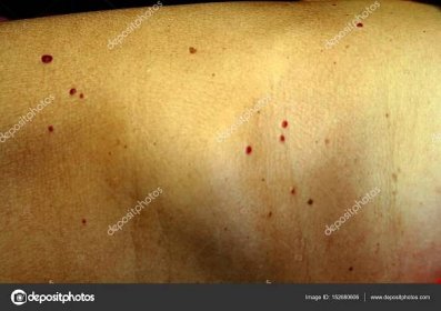 Angioma na kůži. Červené znamének na těle. Mnoho mateřská znaménka. — Stock Fotografie © mikrostoker #152680606