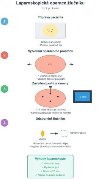 Laparoskopie žlučníku – šetrné řešení pro odstranění žlučových kamenů