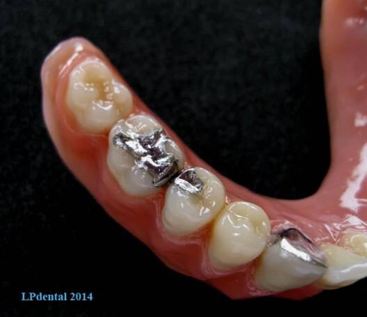 Atypické snímatelné dentální práce | LPdental.cz