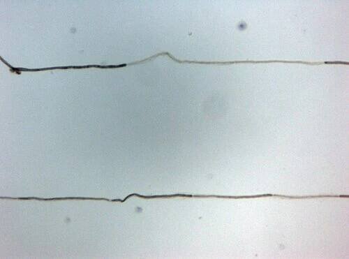 Chronic inflammatory demyelinating polyneuropathy