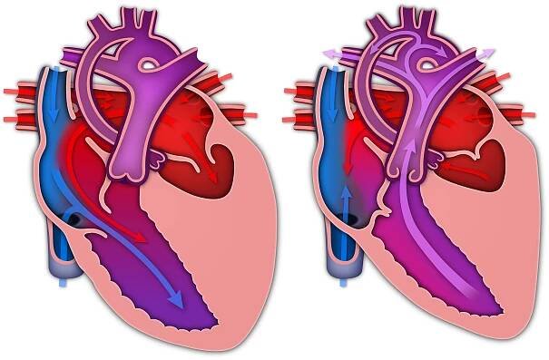HLHS Heart with Arrows
