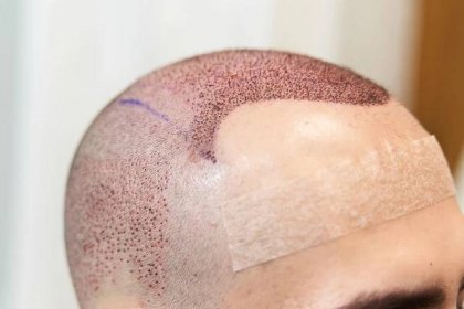 Will There Be a Scar After Hair Transplantation?