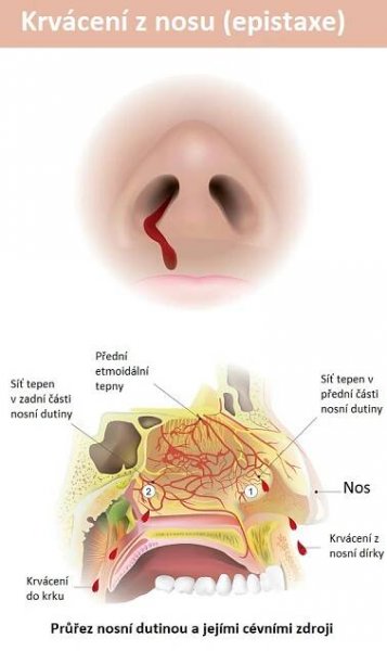 Časté krvácení z nosu (epistaxe) – příčiny & léčba – jak řešit?