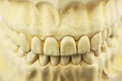 Zubní plíseň za zubní protézu — Stock obrázek