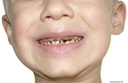 Zkažený zub – význam snu a symbolika