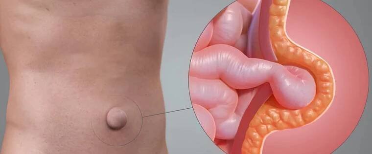 Umbilikálna hernia, hernia v linea alba, hernia v jazve - Medicína a chirurgia