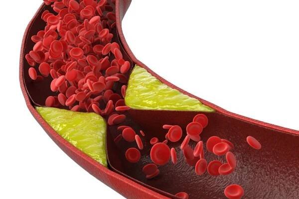 3d podání aterosklerózy s cholesterolem krve nebo plaku v cévách příčina ischemické choroby srdeční — Stock obrázek