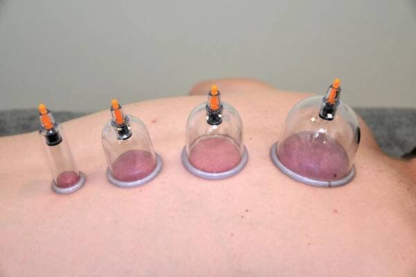 Baňkování, GUA-SHA :: Fyzioterapeutka Bc. Hana Benešová Brno