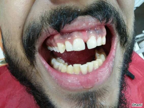 Composite & anterior smile design | Dhami Dental Clinic | Surat