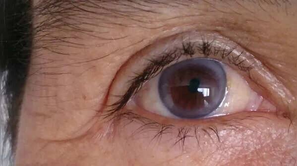 White or gray rings around the eyes – Arcus Senilis