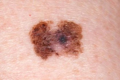 Šupiny na kůži nepodceňujte, může to být rakovina, varuje dermatoložka! Co napoví?
