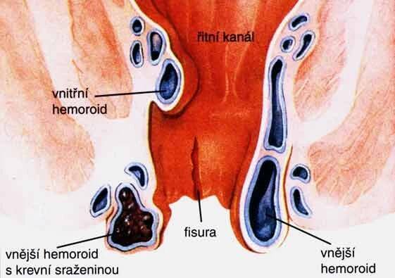 Hemeroidy, hemoroidy - příznaky, projevy, symptomy, obrázek, fotografie