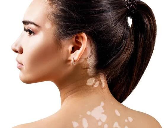 Vitiligo – příčina a léčba