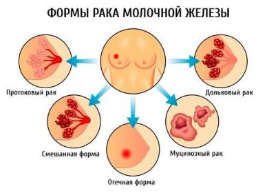 Různé formy rakoviny prsu