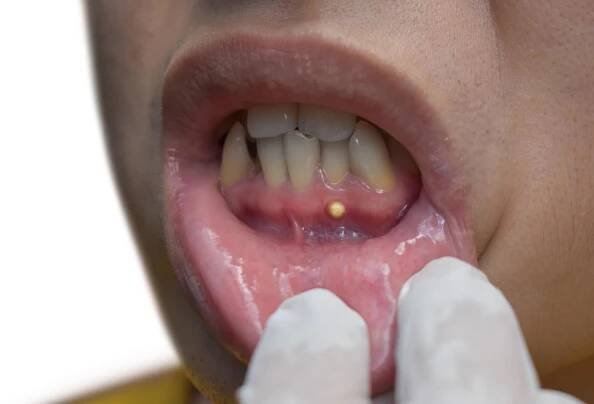 parodontální absces. periapický typ. malá kapsa hnisu v dásně. - vrede - stock snímky, obrázky a fotky