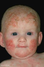 Atopická dermatitida u dětí