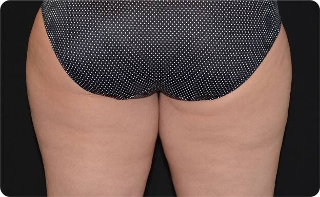 Coolsculpting in Matwan and Monmouth County 