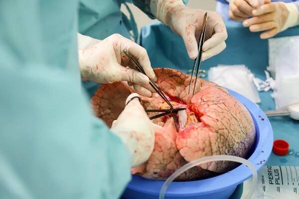 Revoluční systém Lungguard pro převoz plic k transplantaci