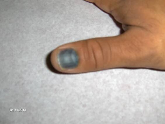 Bleeding Under Nail (Subungual Hematoma) Walk In Clinic Orlando FL - Urgent Care Walk-In Medical Clinic Orlando