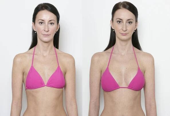 Paní Lenka 30 - Augmentace prsou implantáty | Medicom Clinic
