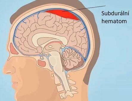Subdurální hematom je druh krvácení uvnitř hlavy (lebky).