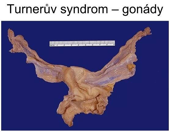 Turnerův syndrom – gonády 