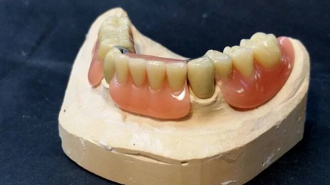 Removable dentures with vario anchor | Sonderen Dental