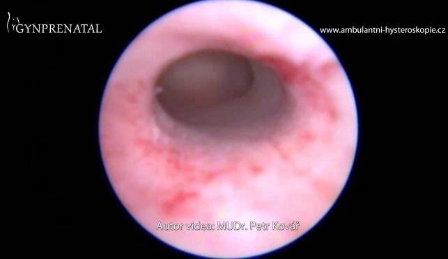 2x drobný endometriální polyp v dutině děložní
