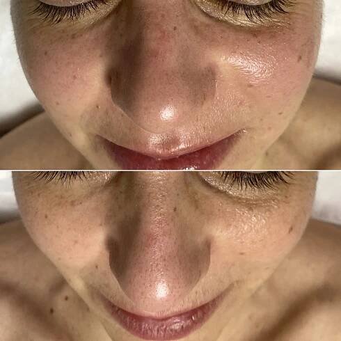 Chemický peeling obličeje, krku a dekoltu včetně hloubkového čištění pleti