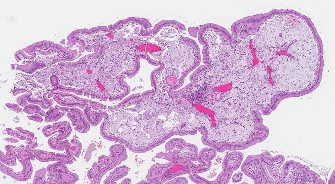 chronická cholecystitida