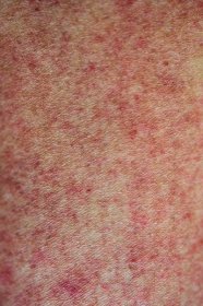 Detailní záběr lidské kůže s červenými vyrážky nebo horečka dengue. — Stock obrázek
