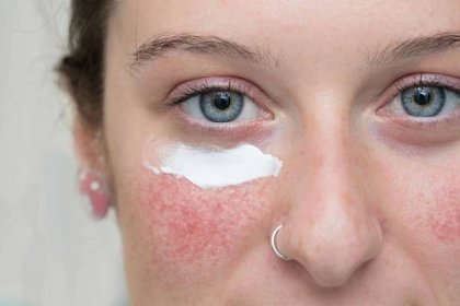 Detailní pohled na hezkou bělošku s lokálním krémem pod okem, přes červenou skvrnitou tvář, lokální ivermectin a azelaová kyselina smetana léčit růžové tváře. — Stock obrázek