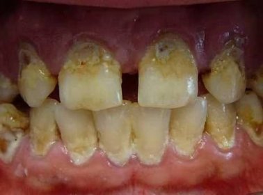 Neléčený zánět zubu: příznaky, příčiny a léčba - Březen 2024 - LaskaVezrozeni.CZ