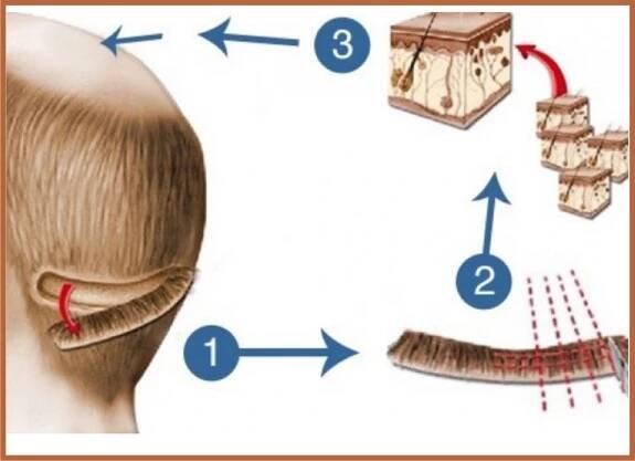 Spiral Skin And Hair Transplant Centre – Spiral Skin Clinic