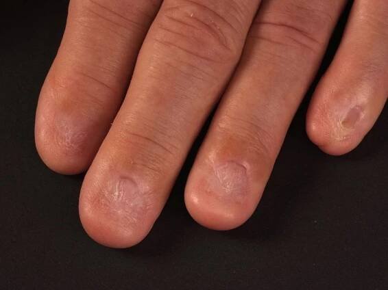 Lichen planus atrophicans