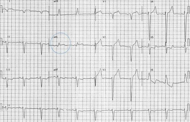 ECG positive sgarbossa criteria with LBBB, 1mm concordant ST elevation in aVL