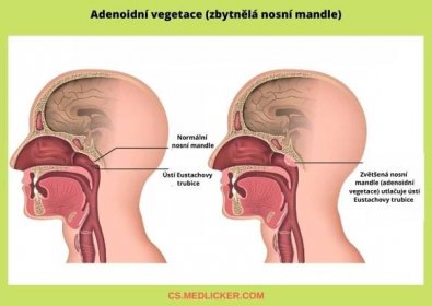 Zbytnělou nosní mandli (adenoidní vegetaci) je vhodné chirurgicky odstranit, protože komprimuje Eustachovu trubici a dutinu nosní a je spojena s opakovanými záněty středouší, chrápáním, huhňáním a dalšími obtížemi
