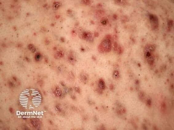 Acne affecting the back images