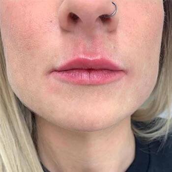Zvětšování rtů - Beauty clinic Synergy