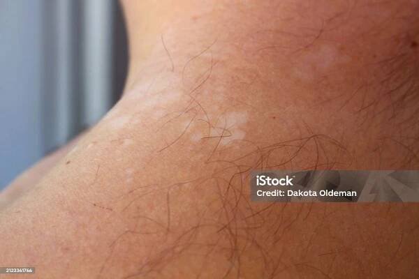 Stock fotografie Porozumění Tinea Versicolor Zvládání A Léčba Pityriasis Versicolor – stáhnout obrázek nyní