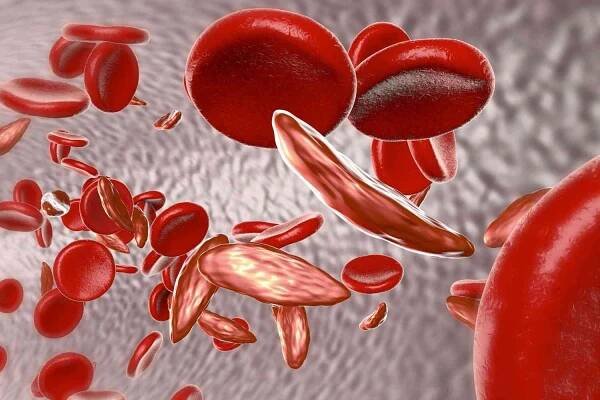 50 Facts About Hemoglobin SC Disease 