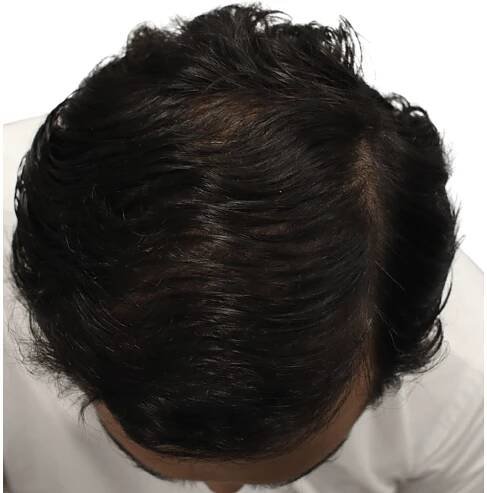 No.1 Hair Transplant Clinic in Ahmedabad | Dr. Aanchal Shah | Zeeva Clinic