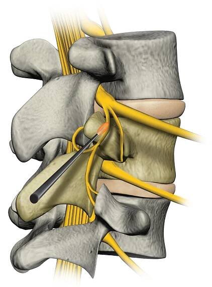 Dr. Matthias Wolf, Orthopäde, Behandlungen, ACP Eigenbluttherapie