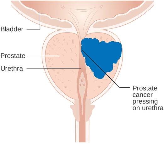 Urologist for Prostatitis in Farmington, NM | Adult & Pediatric Urology, LLC