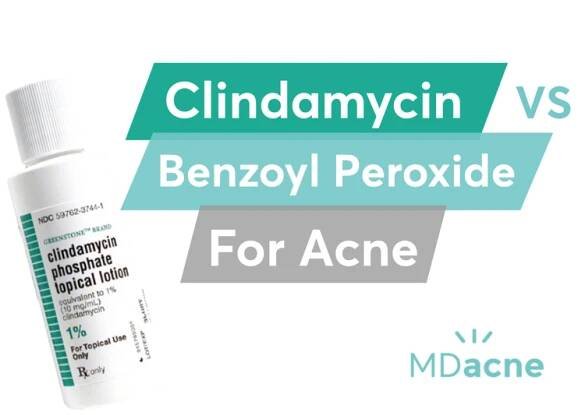 Is Clindamycin Better than Benzoyl Peroxide for Acne?