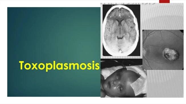 Toxoplasmosis
 