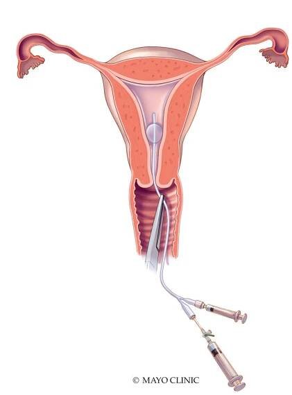 Hysterosalpingography