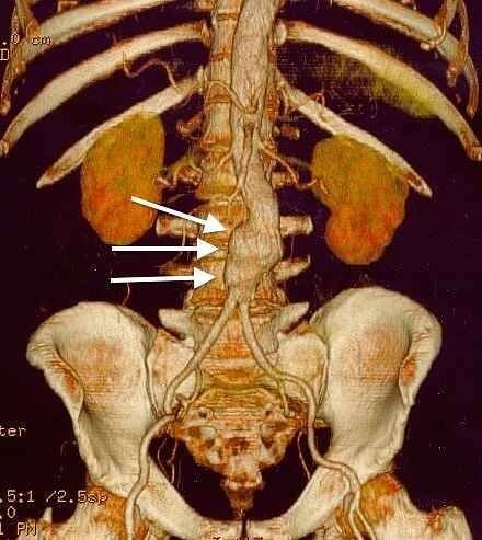 3D rekonstrukce CT skenu aneuryzmatu břišní aorty.