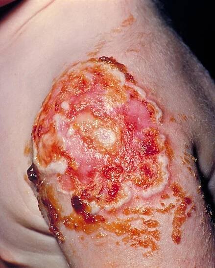 Progressive vaccinia